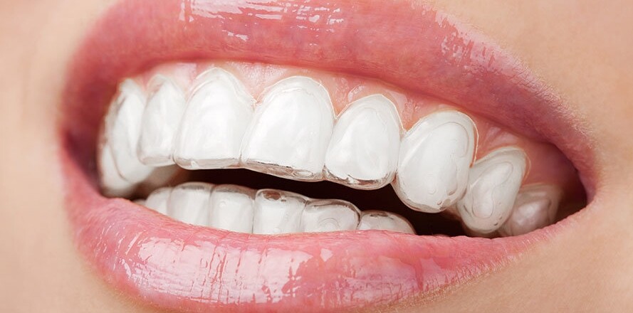 Clear Teeth Aligners | Dentist Gregory Hills | Fairfield