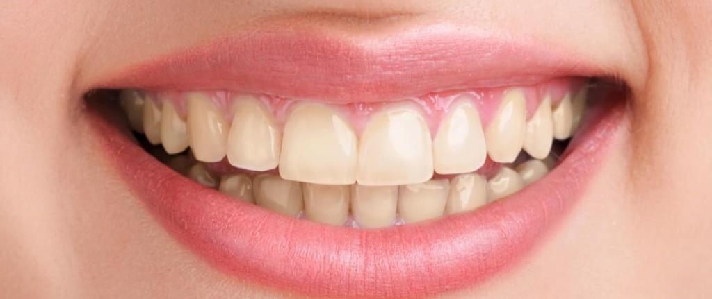 Teeth-whitening-dental-treatment-services-in-sydney