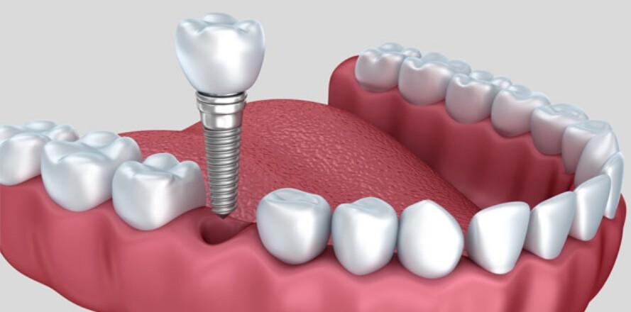 dental-implants-by-smiles-unlimited-in-Fairfield-and-Greater-Sydney-regions