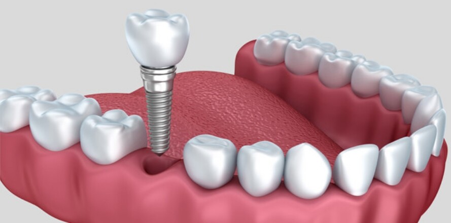 Best dental implants in Fairfield & Gregory Hills | Smiles Unlimited