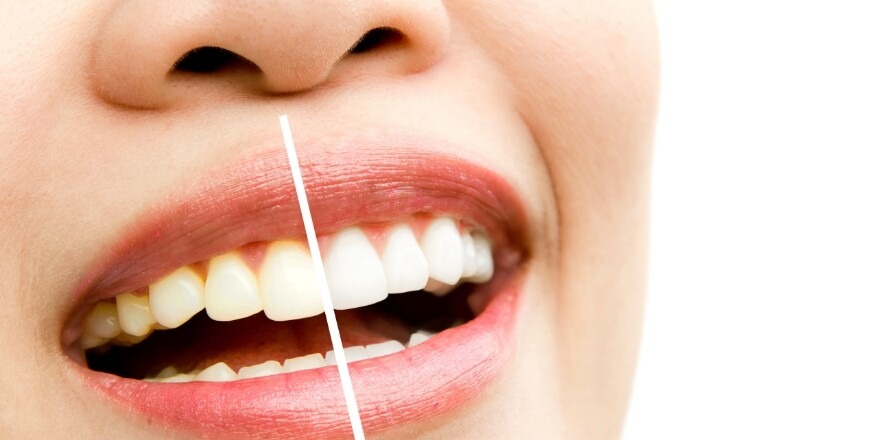 How-much-does-it-usually-cost-to-get-your-teeth-whitened-or-teeth-whitening-at-sydney