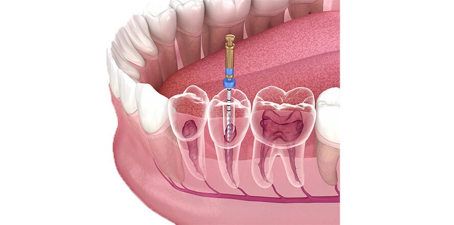 Root-Canal-Procedure-and-cost