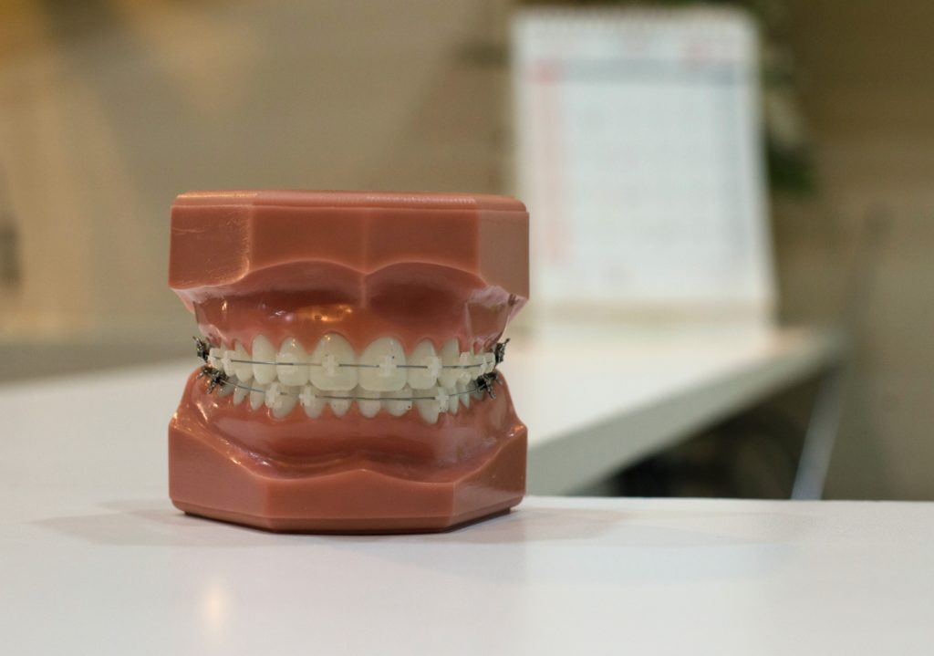 Braces metal by smiles unlimited dentist