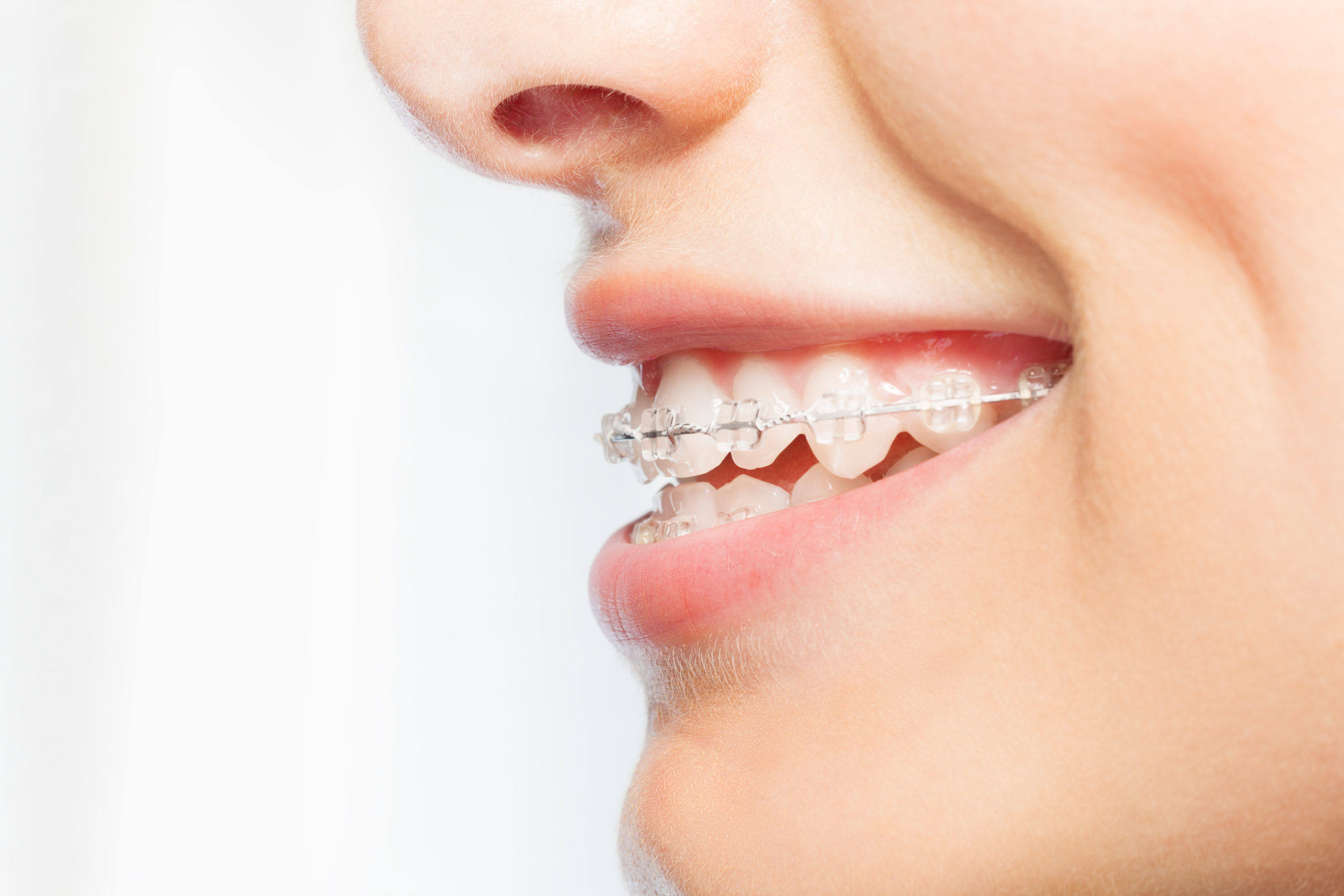 Women smile with clear braces