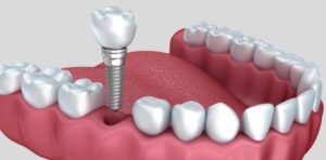 care for your dental implants