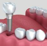 Dental Implants vs. Dentures - Benefits of Dental Implants