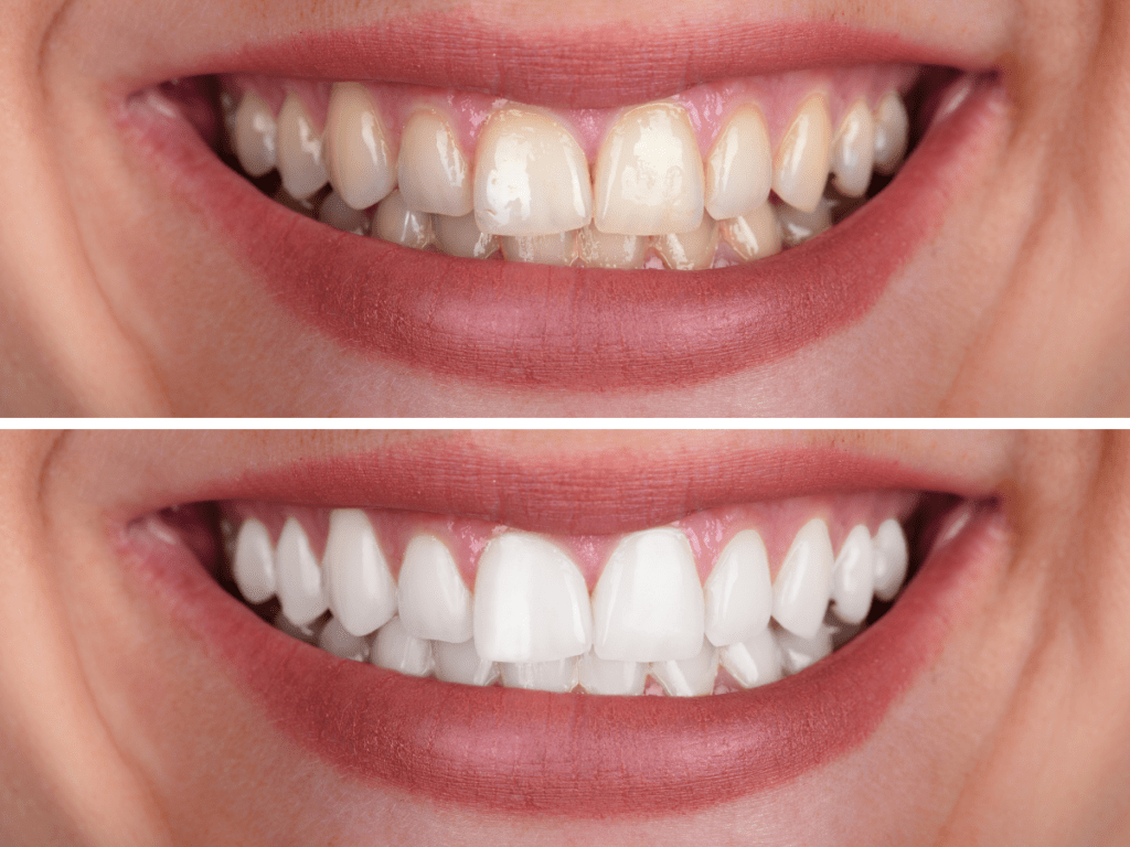 Smiles-Unlimited-Teeth-Whitening-Services-Fairfield