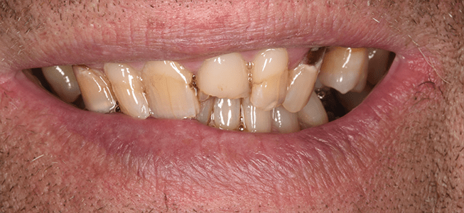 Teeth Before Cosmetic