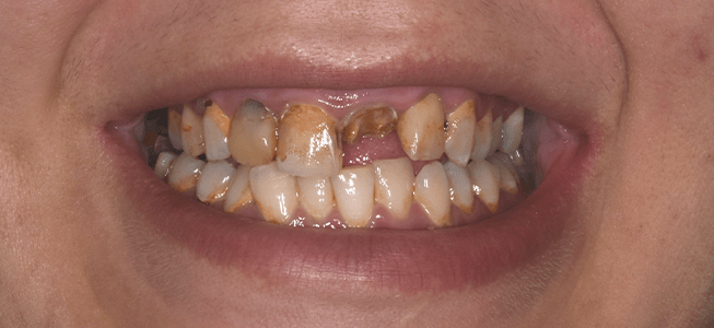 uneven teeth