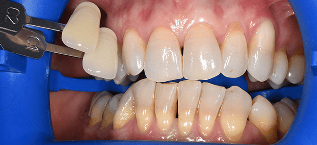 yellowing in teeth