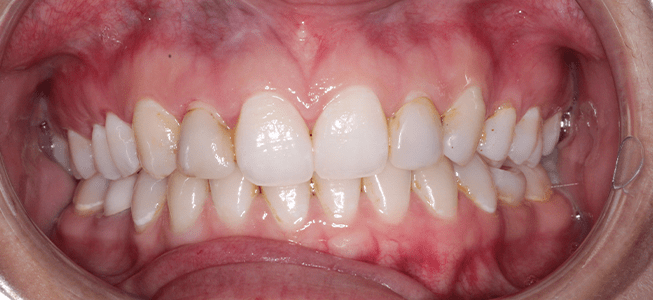 Pain in teeth